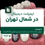 ایمپلنت دیجیتال در شمال تهران