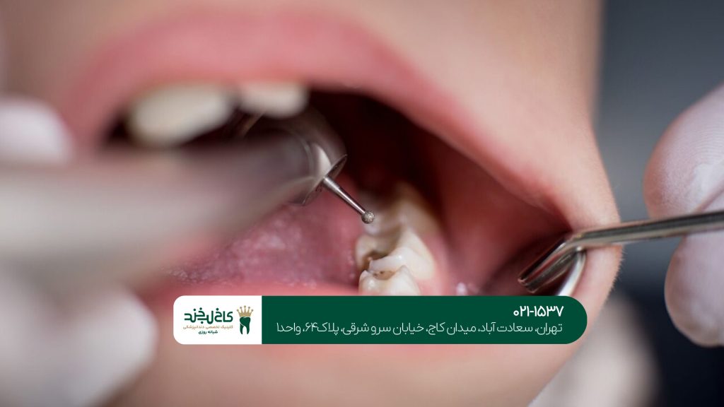 کلینیک عصب کشی