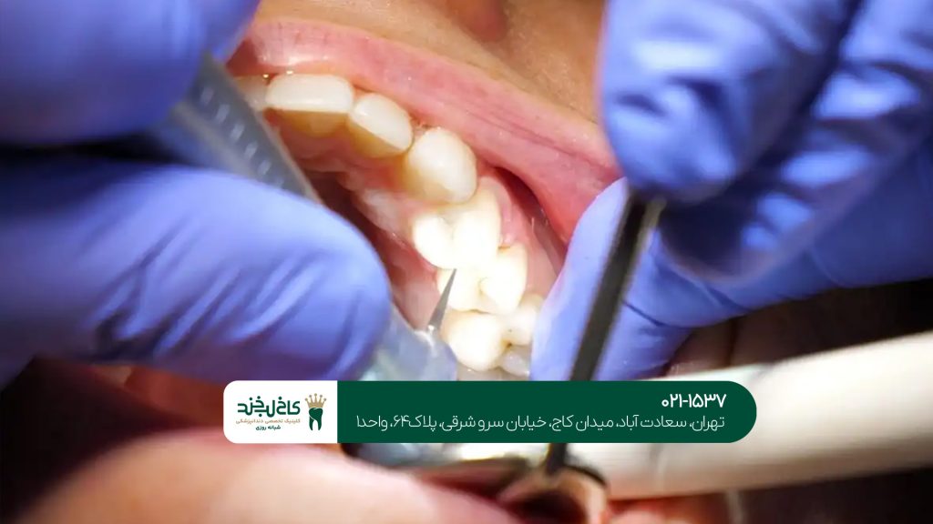 عصب‌ کشی دندان