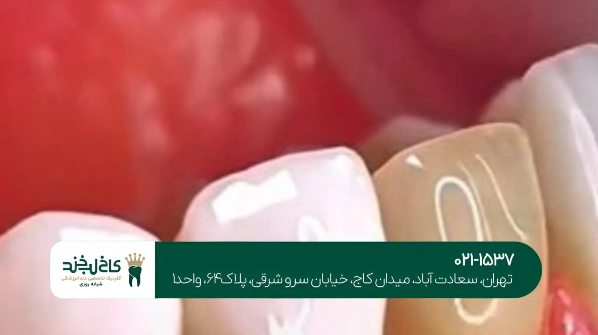 بهترین روش سفید کردن دندان ها