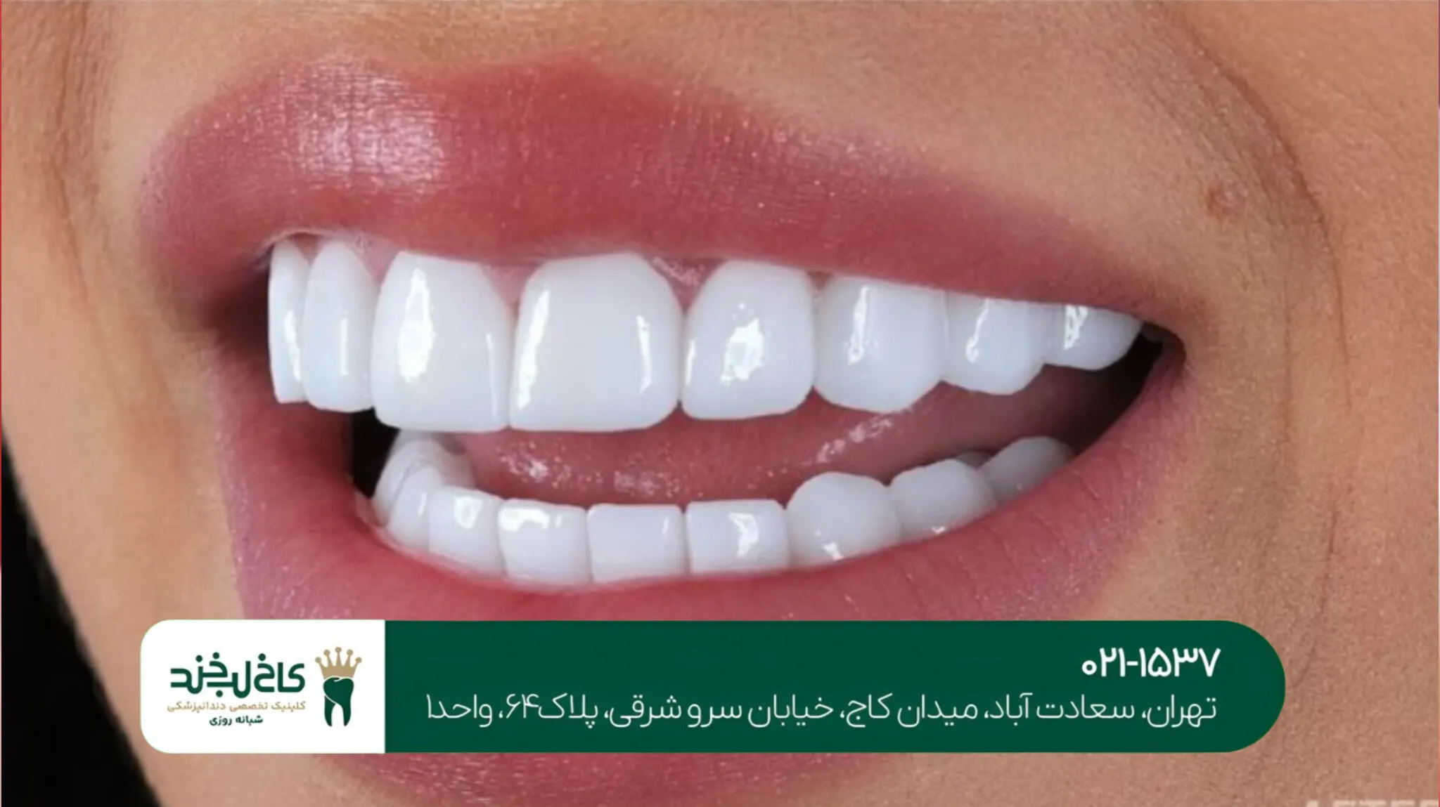 بهترین روش سفید کردن دندان ها