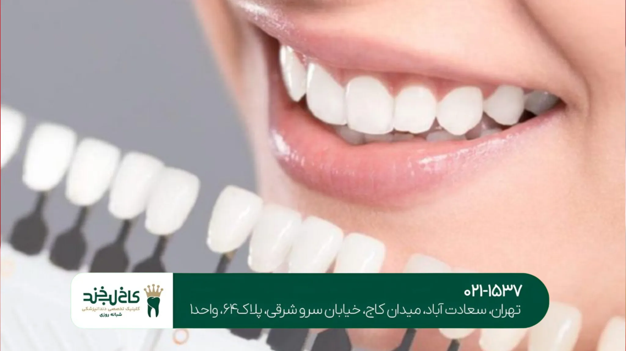 بهترین روش سفید کردن دندان ها