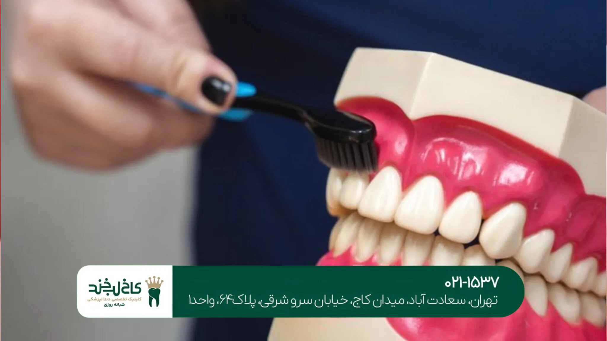 مراقبت های بعد از ایمپلنت دندان