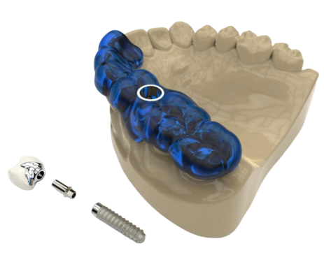 ایمپلنت دیجیتال