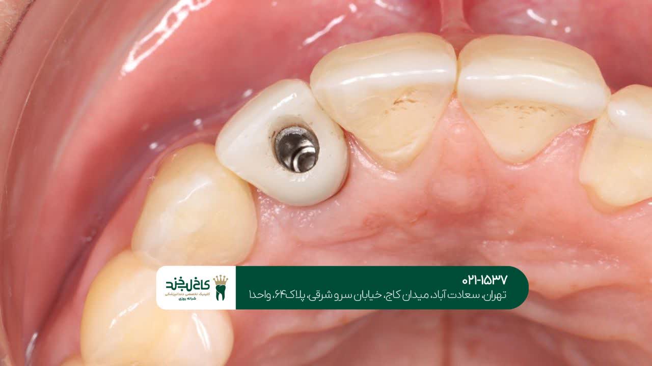 بهترین نوع ایمپلنت دندان