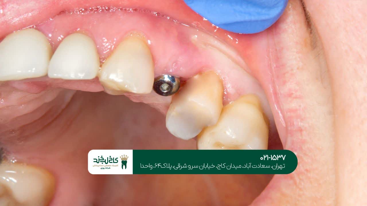 بهترین نوع ایمپلنت دندان
