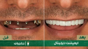 لمینت
