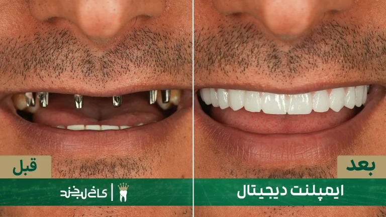 لمینت