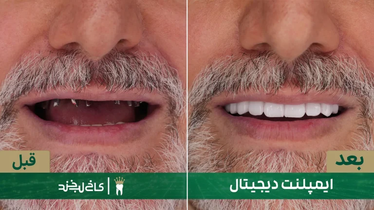 ایمپلنت دندان