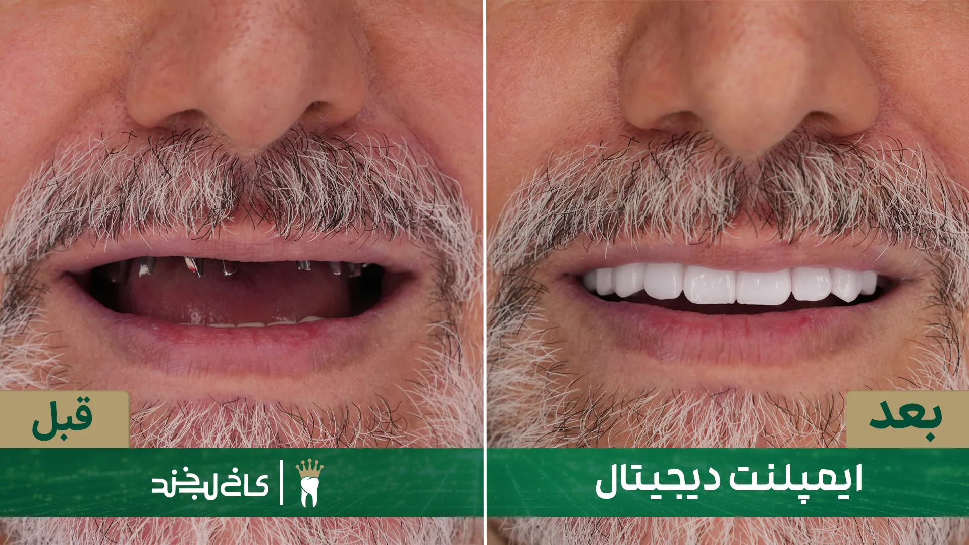 ایمپلنت دندان