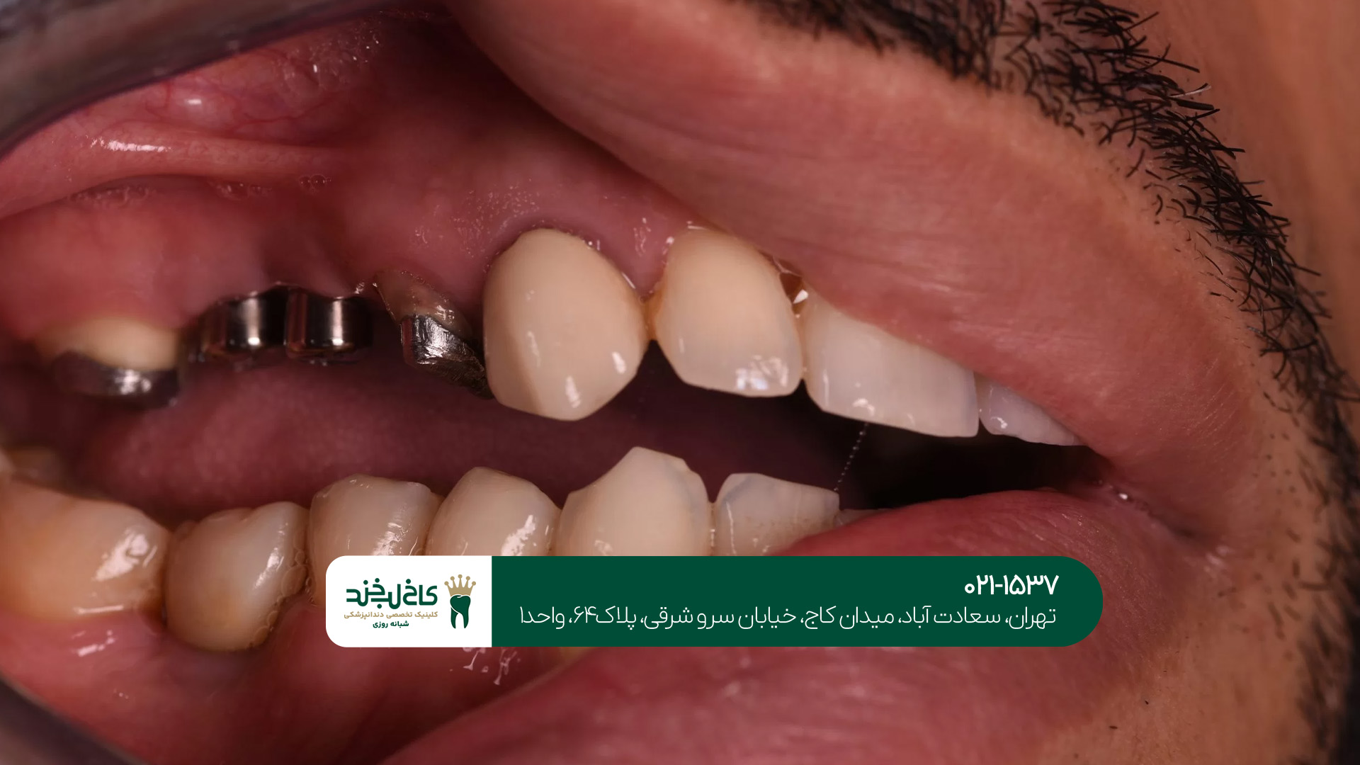 آیا ایمپلنت دیجیتال درد دارد؟ آیا ایمپلنت دیجیتال درد دارد؟