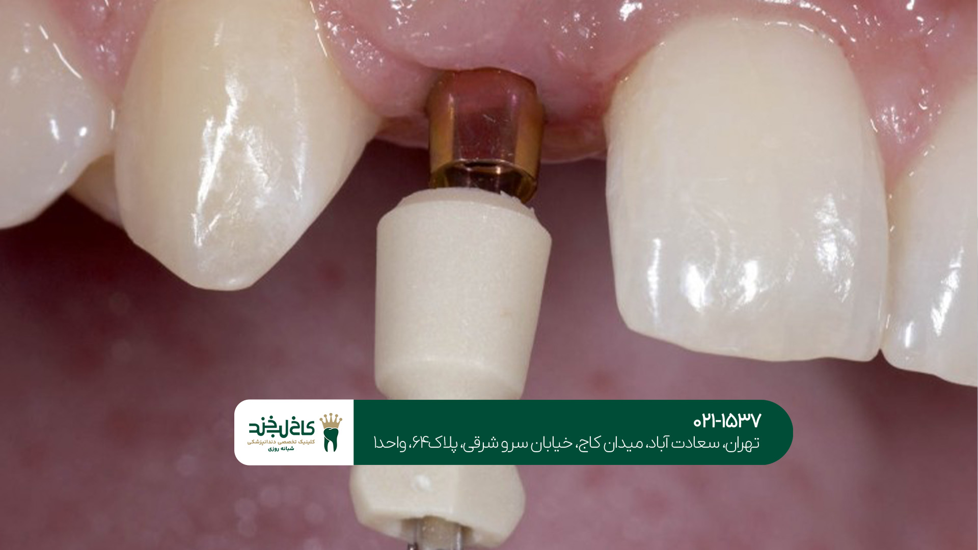 آیا ایمپلنت دیجیتال درد دارد؟ آیا ایمپلنت دیجیتال درد دارد؟