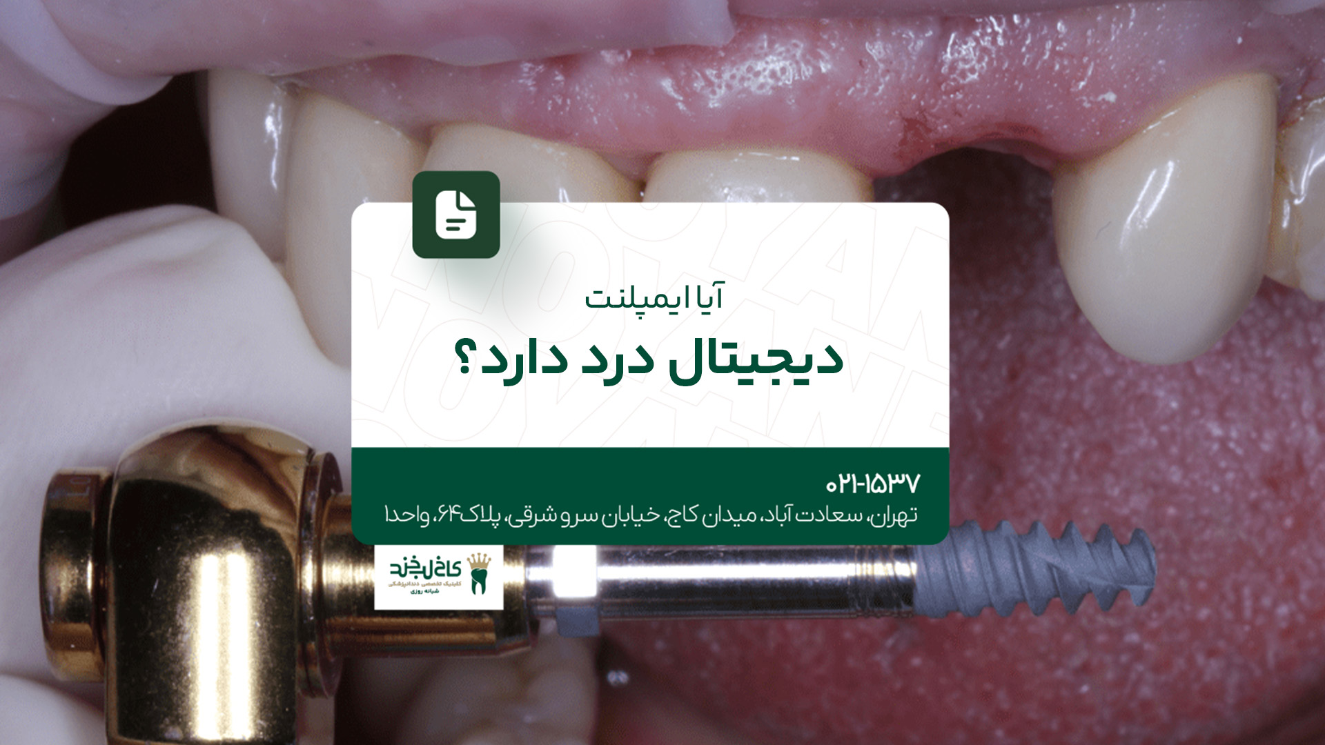 آیا ایمپلنت دیجیتال درد دارد؟ آیا ایمپلنت دیجیتال درد دارد؟
