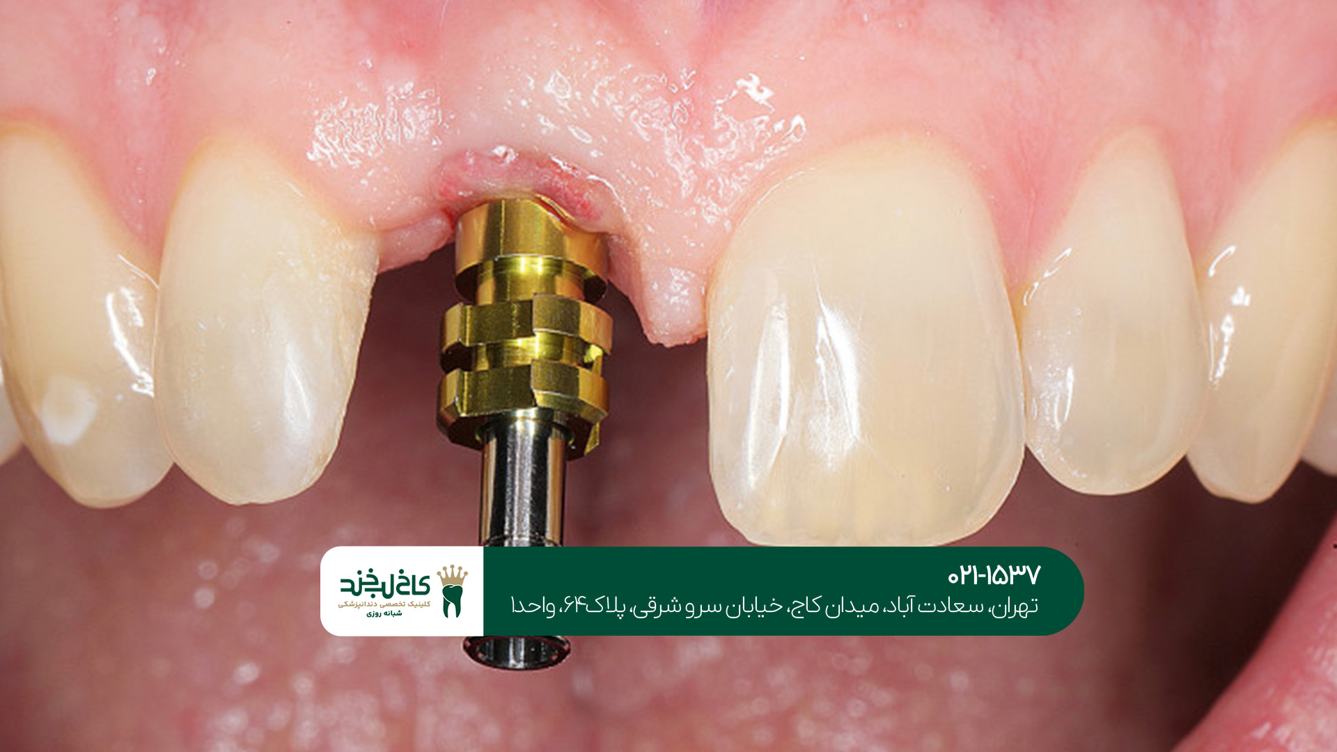 آیا ایمپلنت دیجیتال درد دارد؟ آیا ایمپلنت دیجیتال درد دارد؟