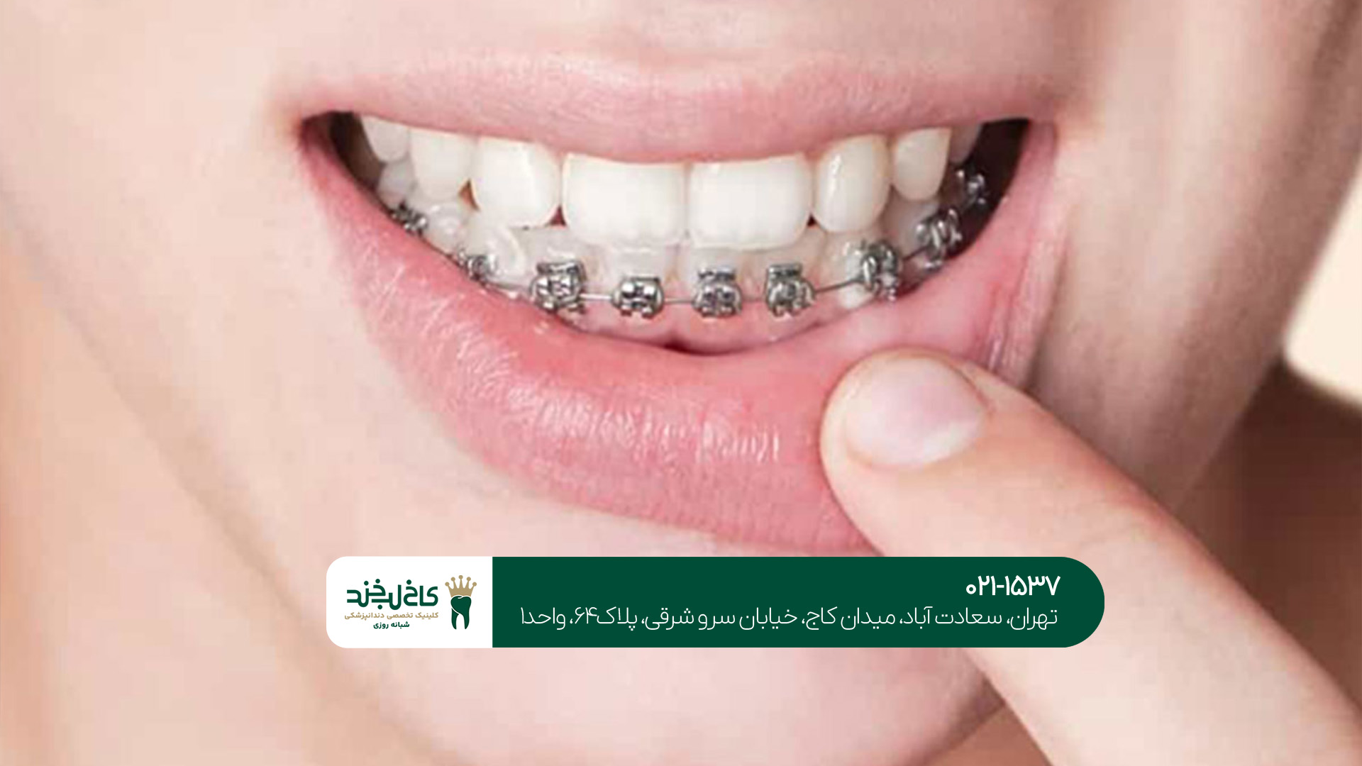 ارتودنسی دیجیتال در جنوب تهران ارتودنسی دیجیتال در جنوب تهران