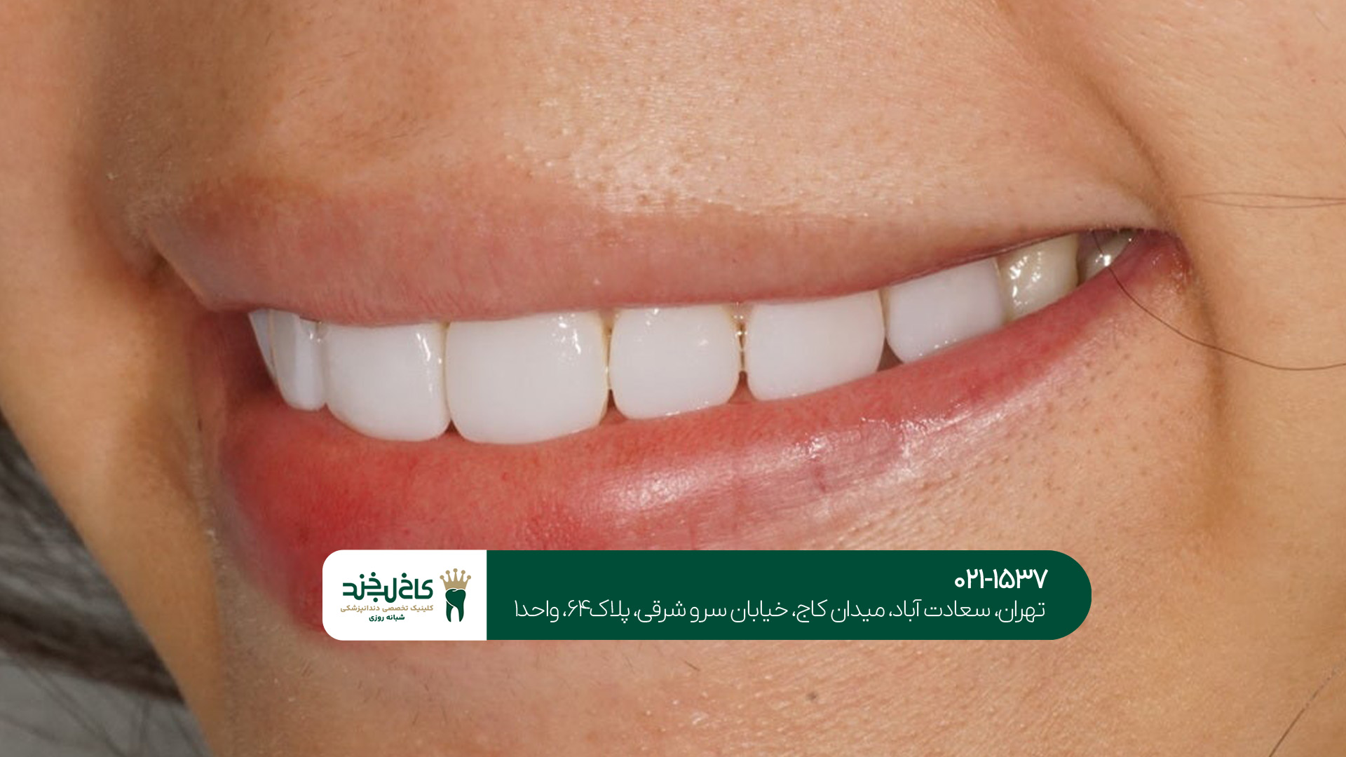 اصلاح طرح لبخند بدون تراش دندان اصلاح طرح لبخند بدون تراش دندان