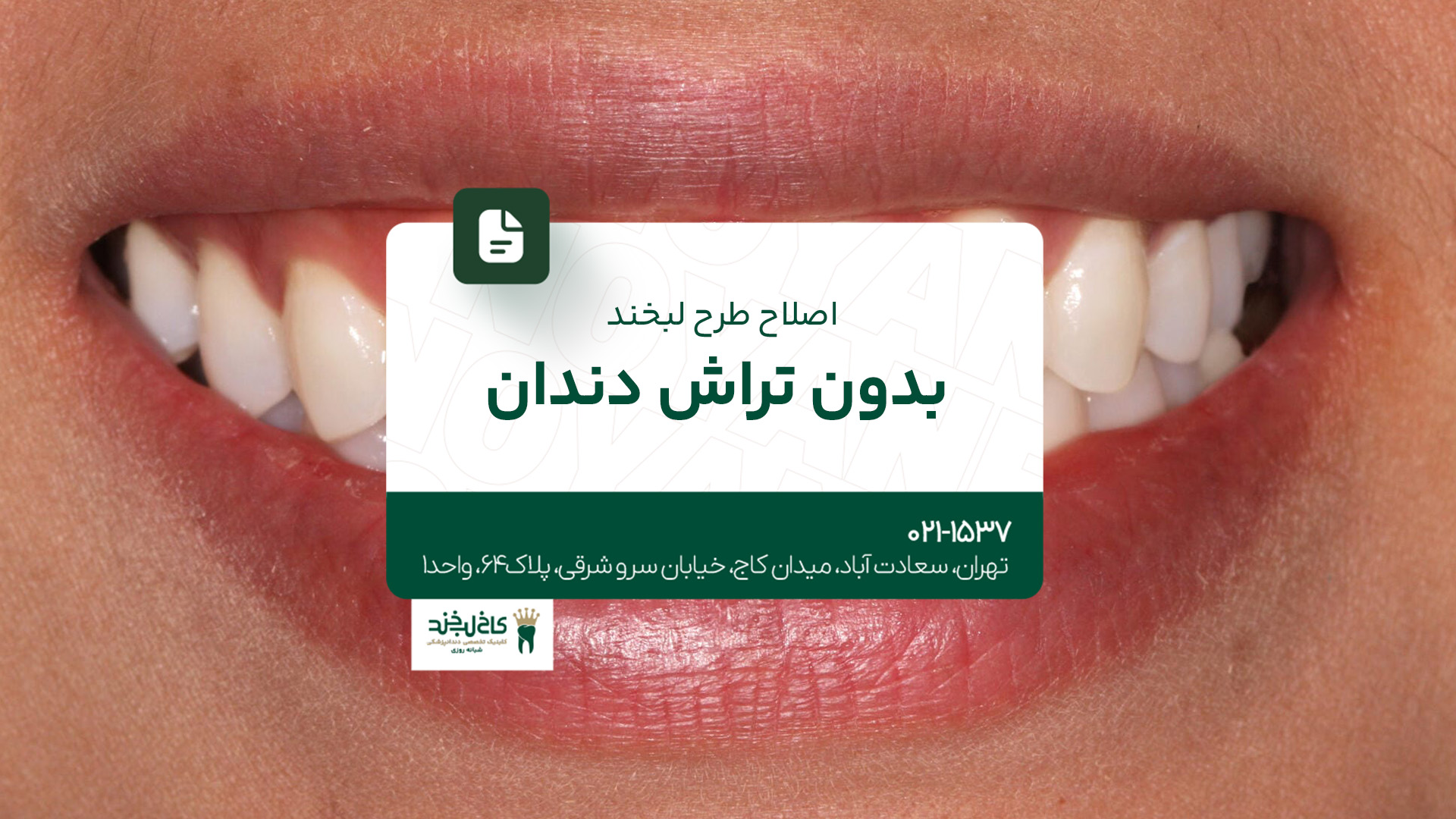 اصلاح طرح لبخند بدون تراش دندان اصلاح طرح لبخند بدون تراش دندان
