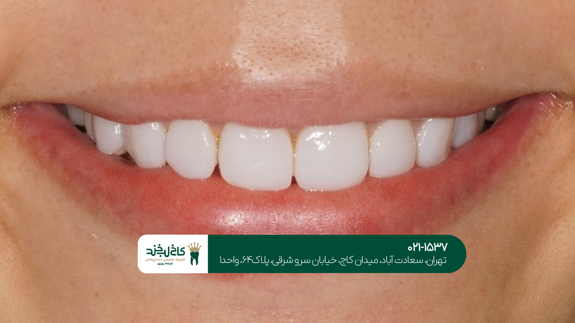اصلاح طرح لبخند بدون تراش دندان اصلاح طرح لبخند بدون تراش دندان
