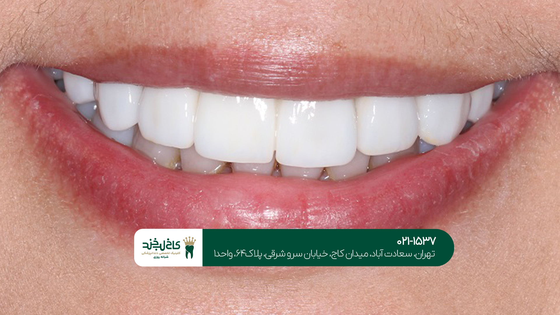 اصلاح طرح لبخند بدون تراش دندان اصلاح طرح لبخند بدون تراش دندان