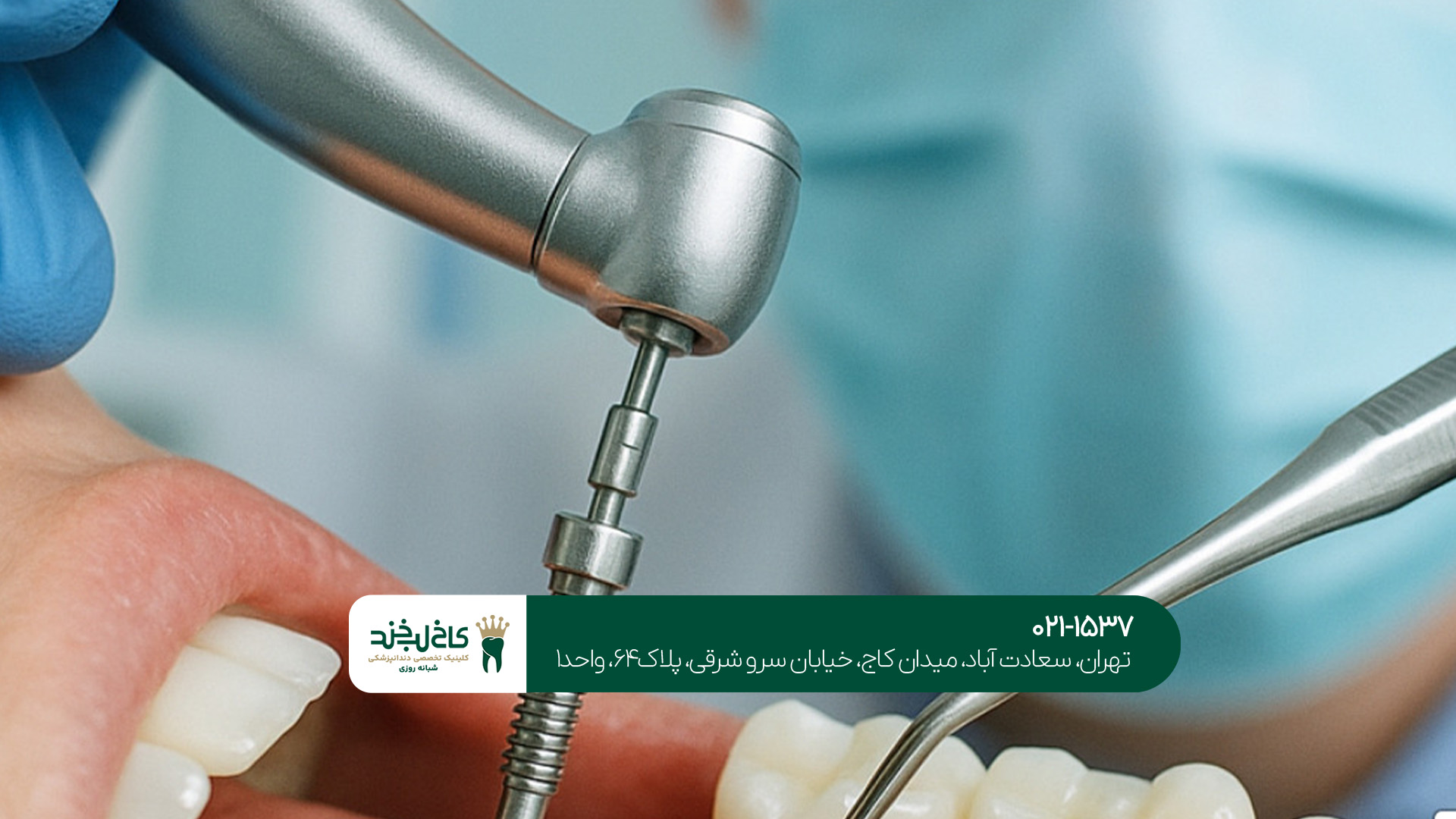 ایمپلنت دندان در جردن