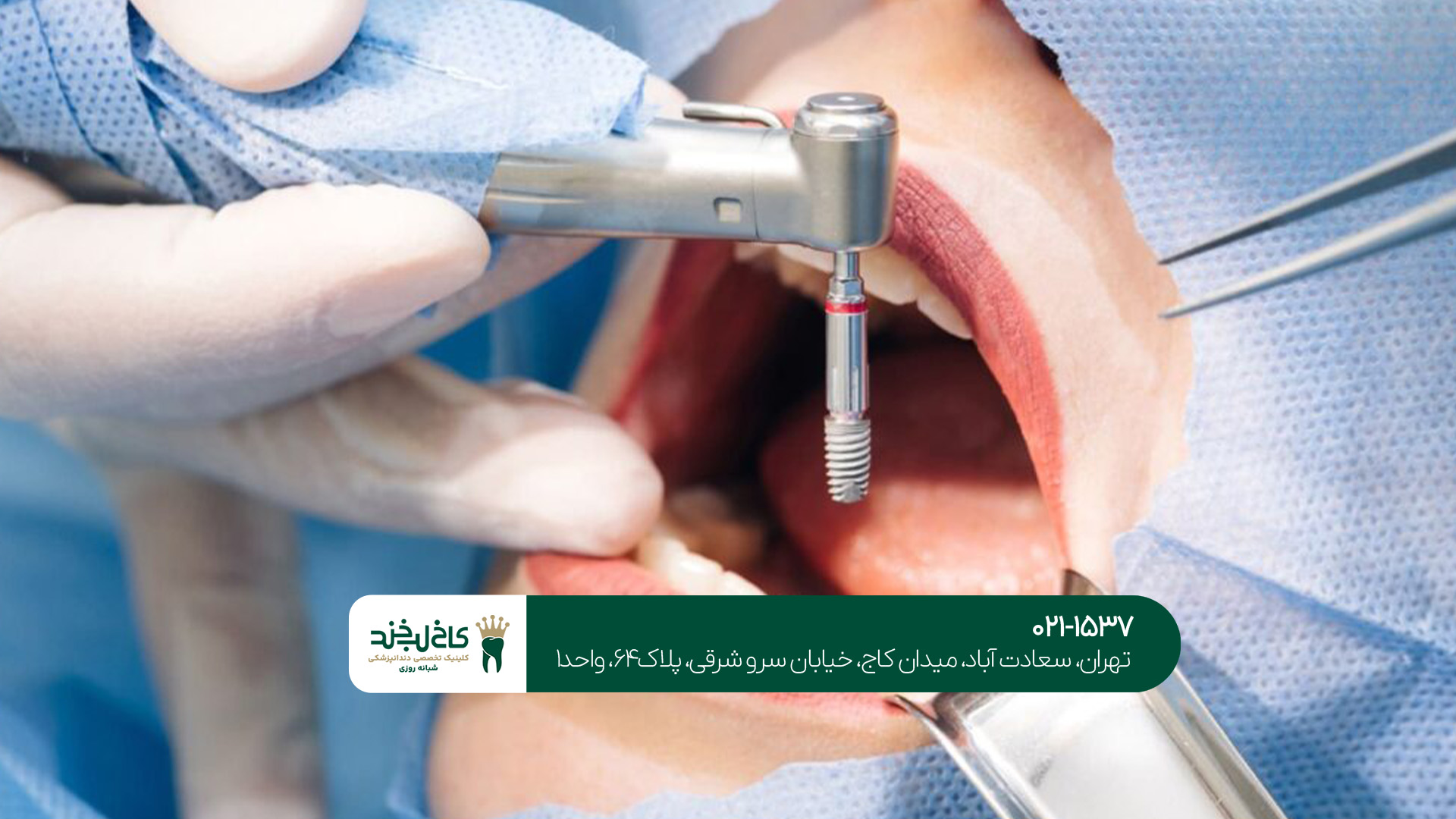 ایمپلنت دندان در جردن