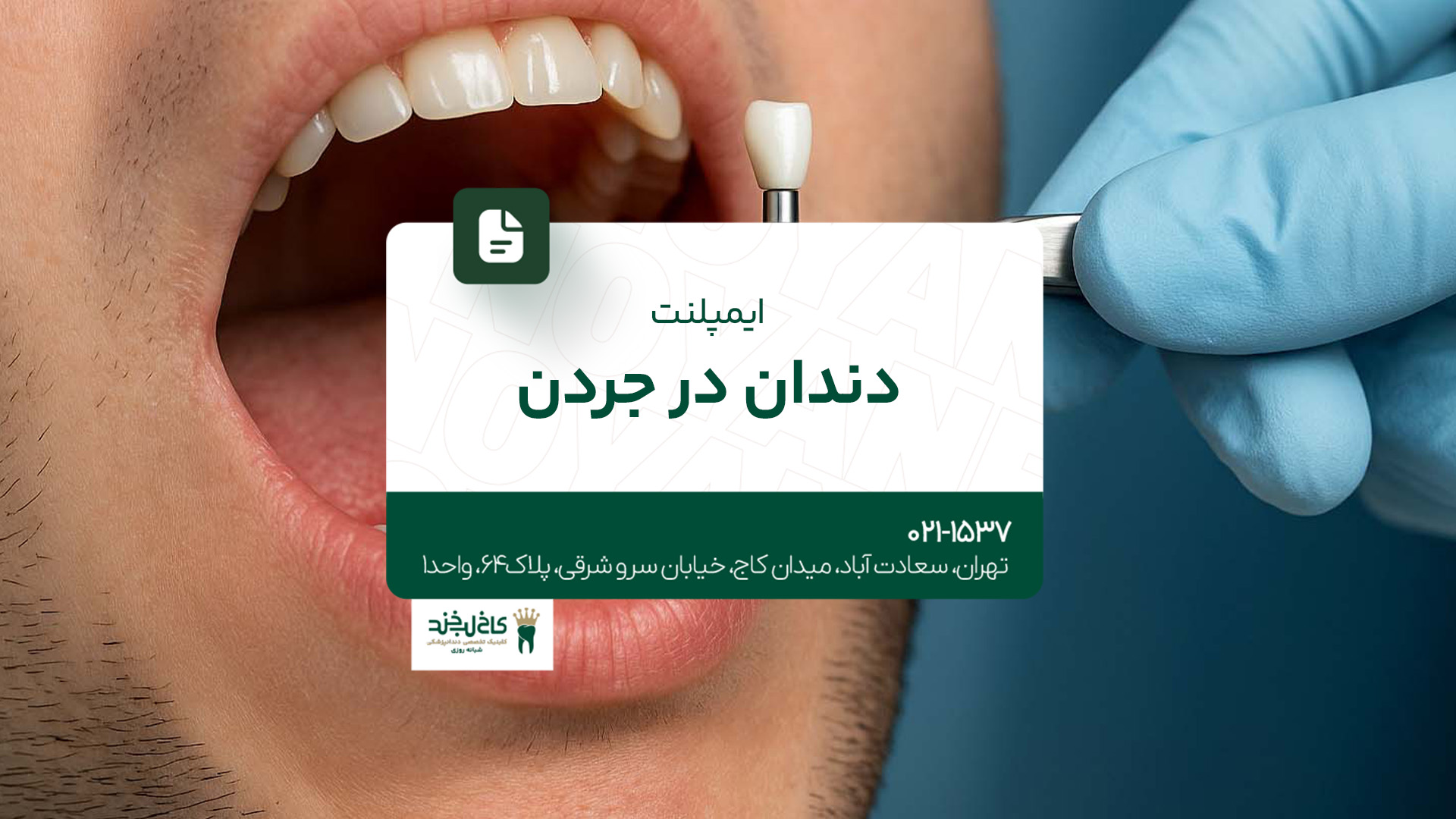 ایمپلنت دندان در جردن