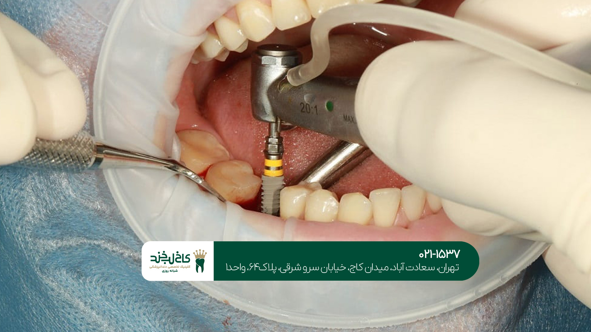 ایمپلنت دندان در سعادت آباد ایمپلنت دندان در سعادت آباد