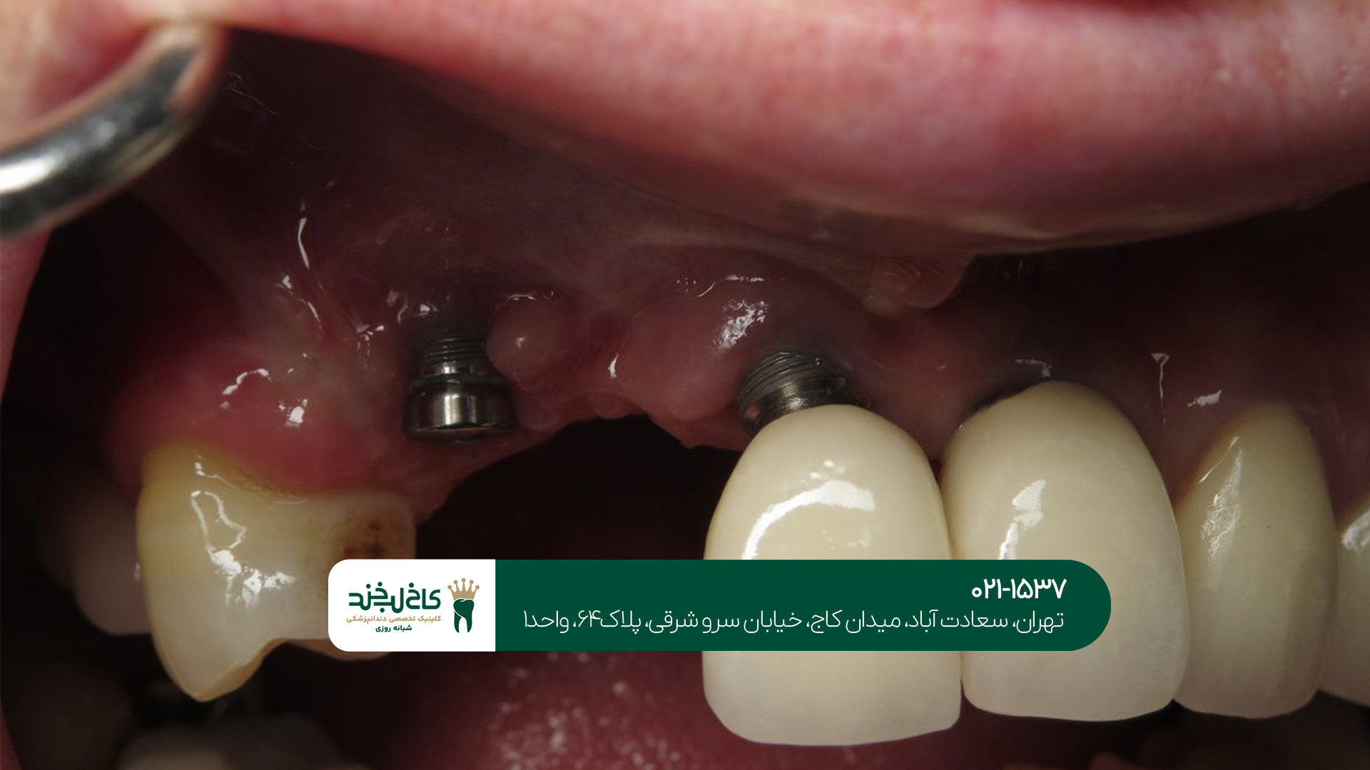 ایمپلنت دندان در سعادت آباد ایمپلنت دندان در سعادت آباد
