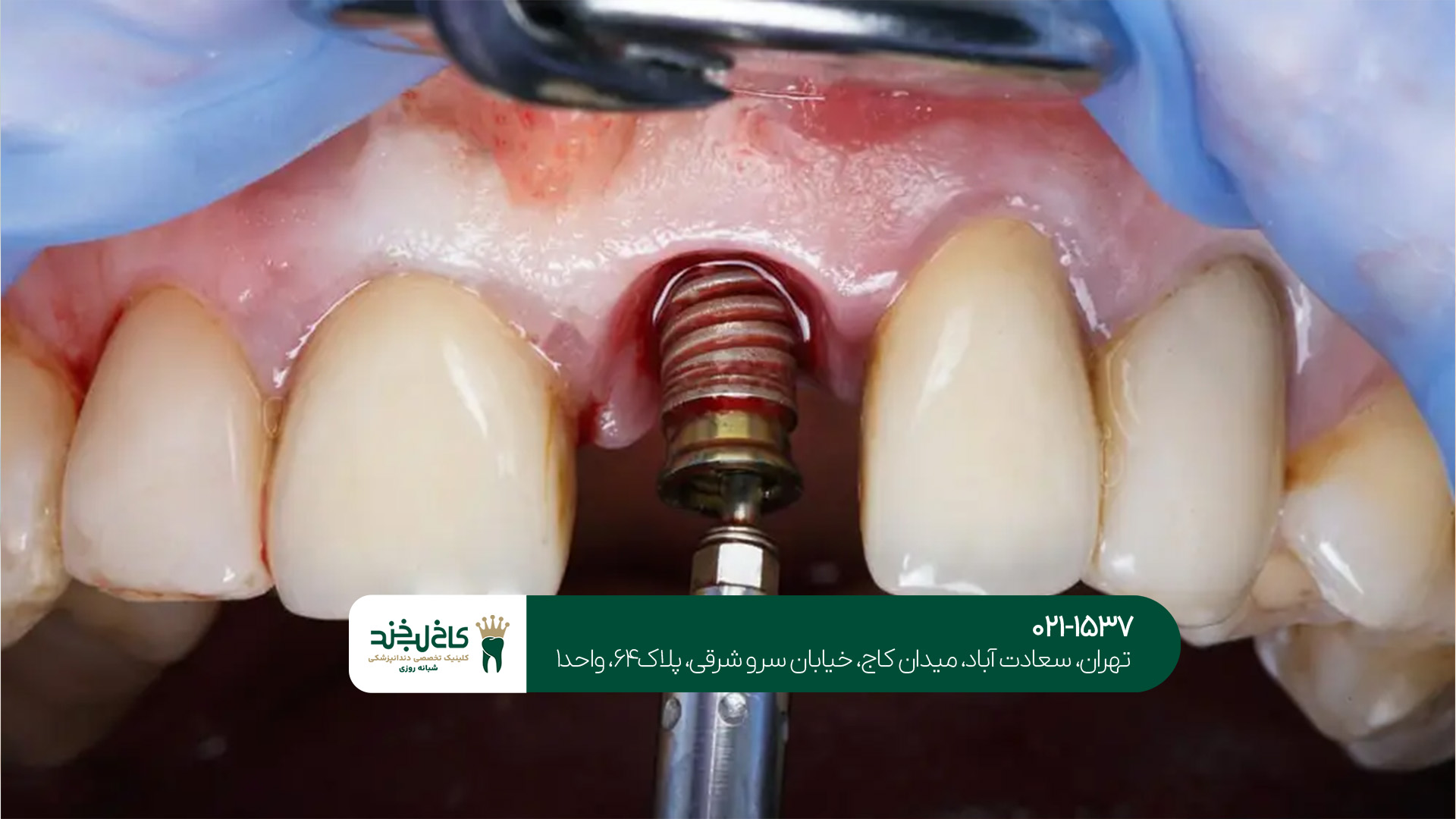 ایمپلنت دندان در سعادت آباد ایمپلنت دندان در سعادت آباد