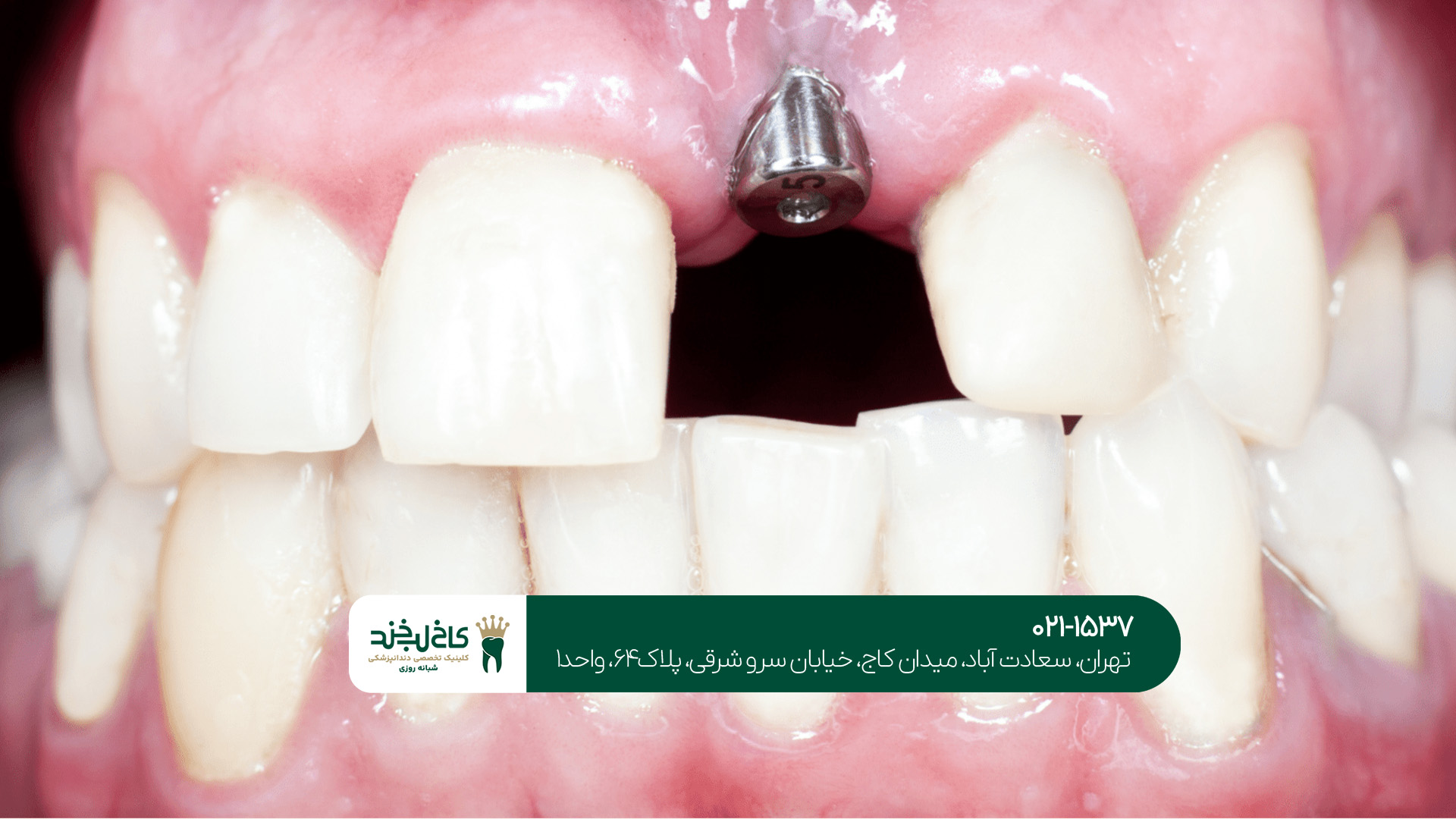 ایمپلنت دندان یک روزه در تهران