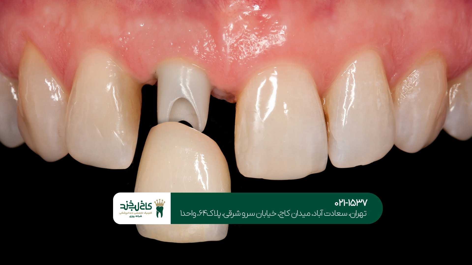 ایمپلنت دندان یک روزه در تهران