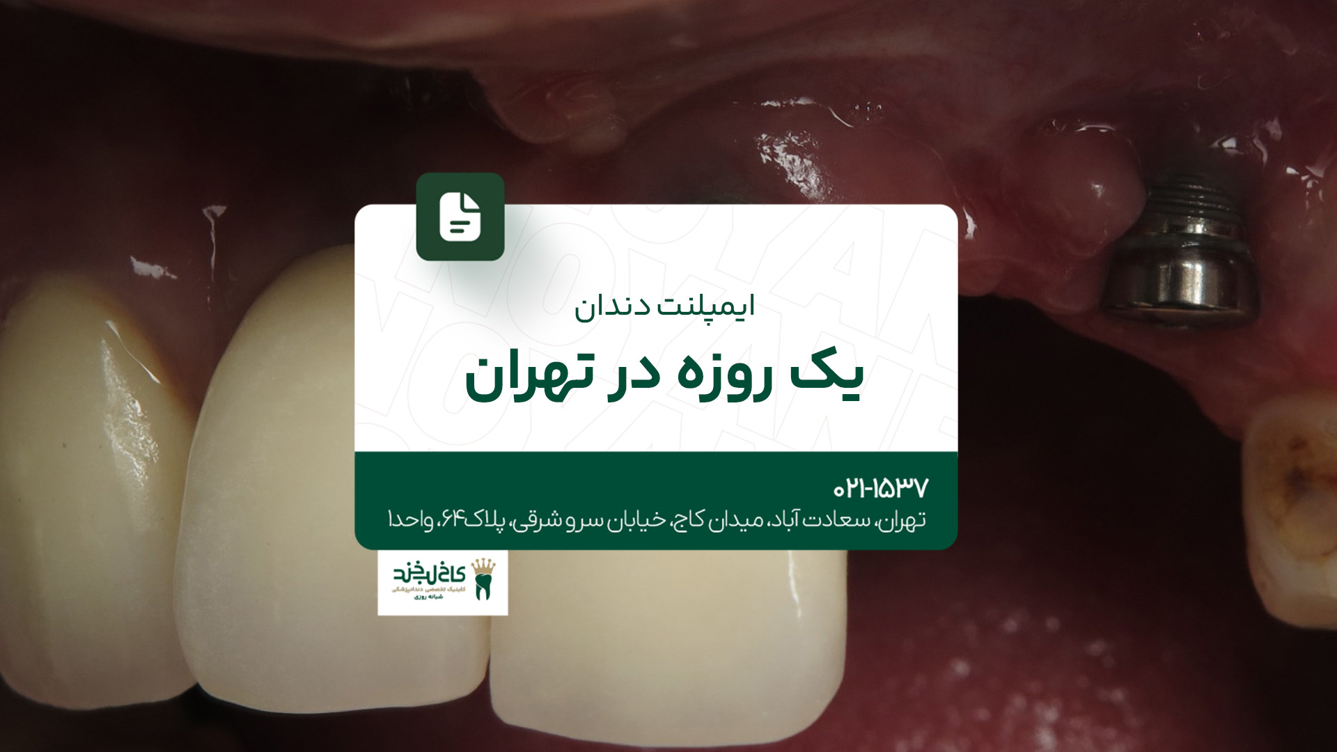 ایمپلنت دندان یک روزه در تهران