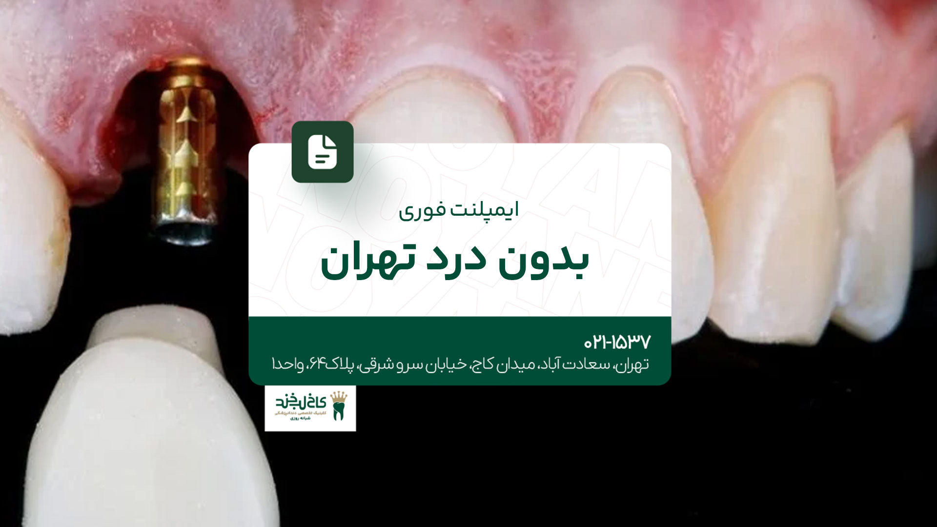 ایمپلنت فوری بدون درد در تهران
