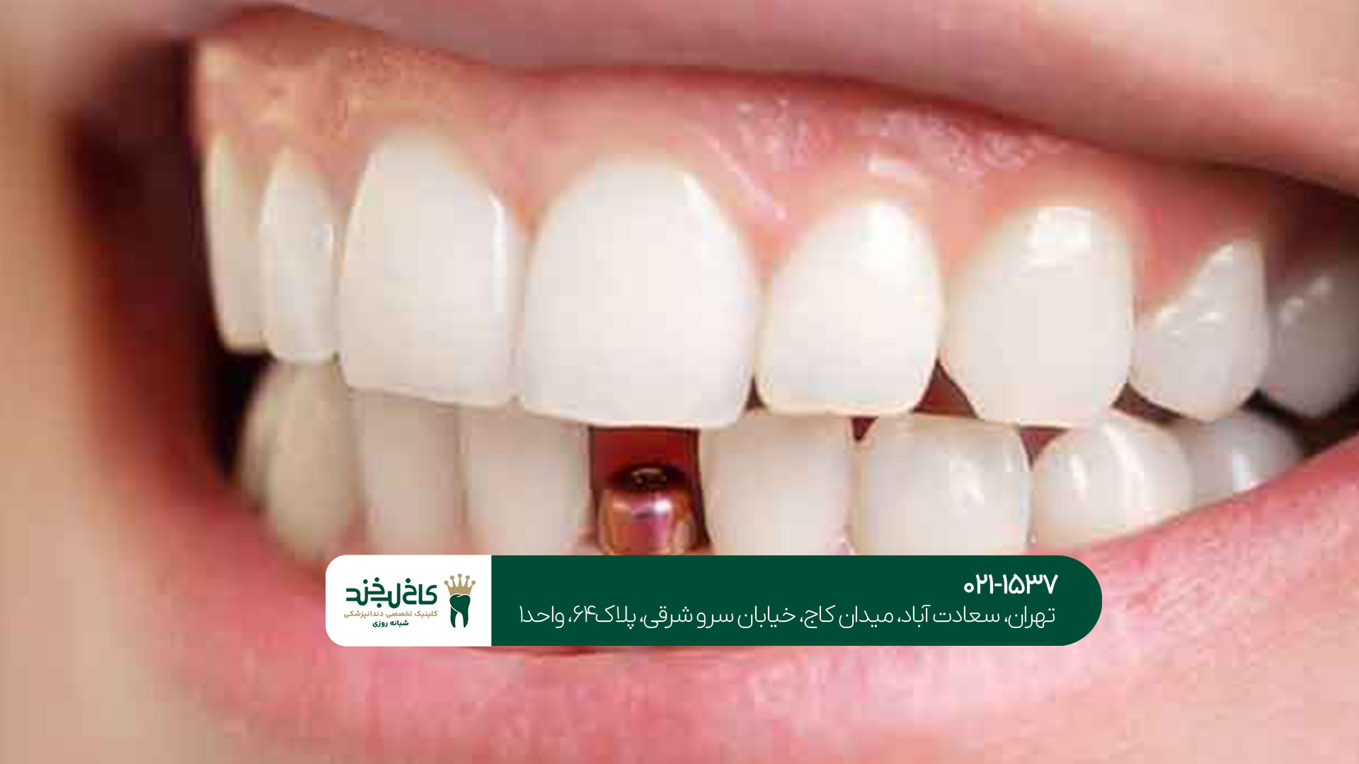 ایمپلنت فوری در سعادتآباد ایمپلنت فوری در سعادتآباد