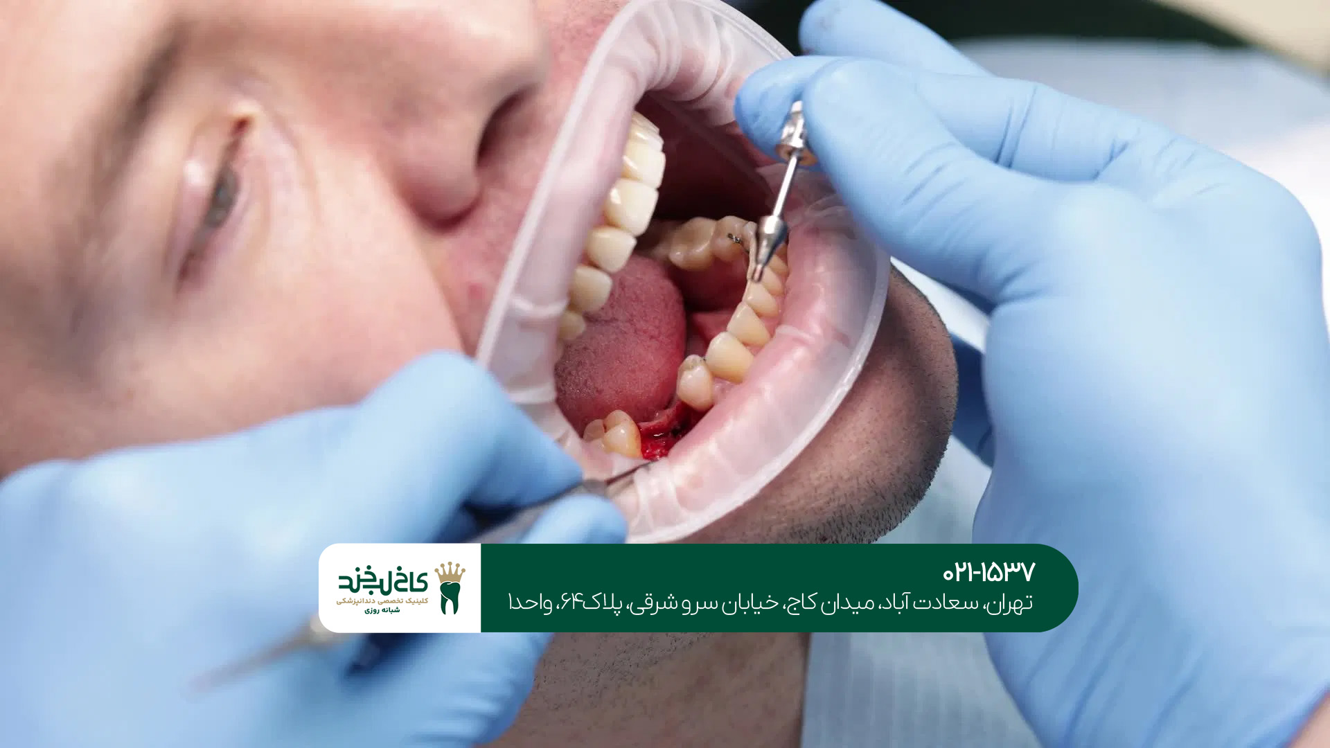 ایمپلنت فوری در سعادتآباد ایمپلنت فوری در سعادتآباد