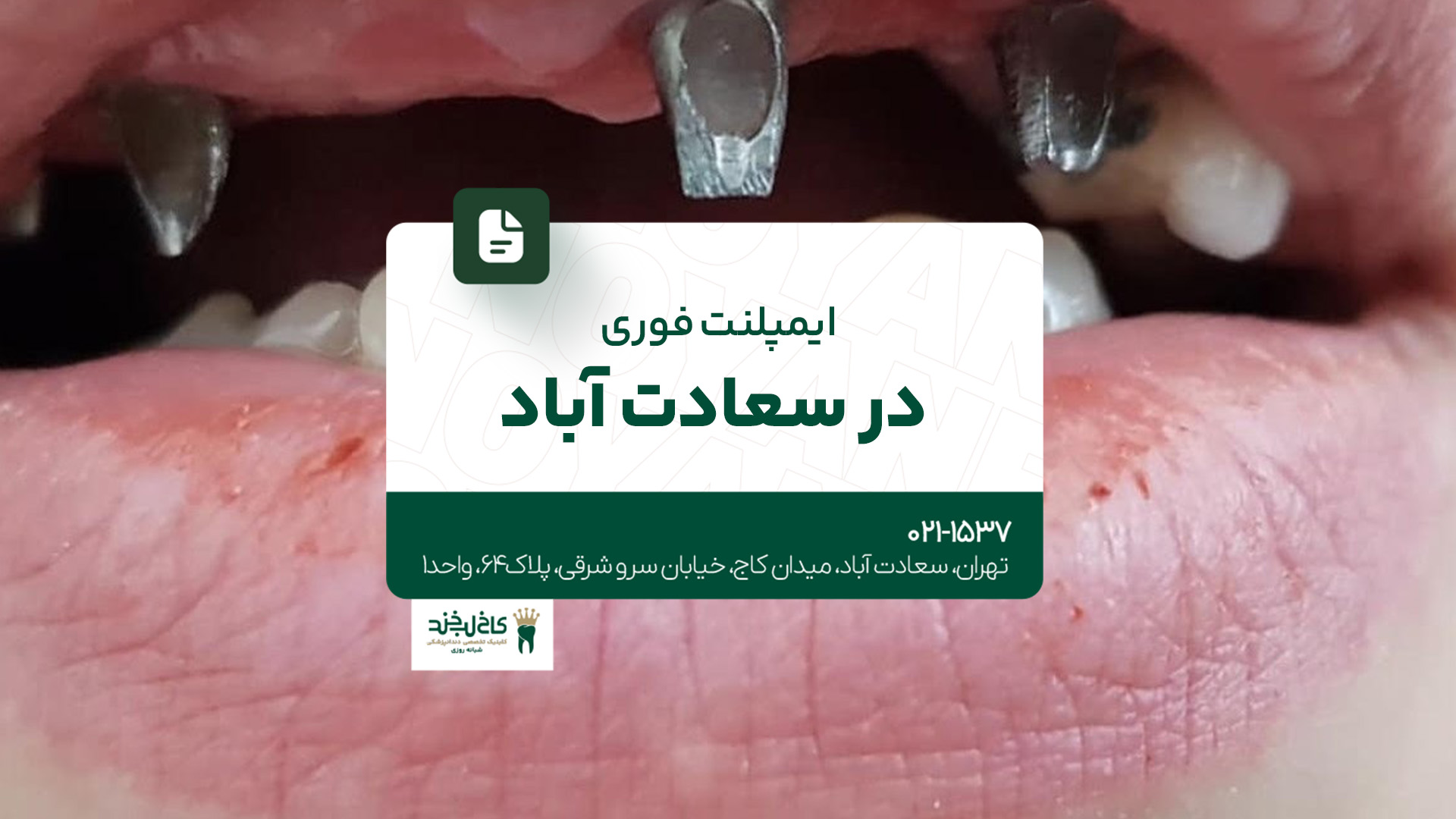 ایمپلنت فوری در سعادتآباد ایمپلنت فوری در سعادتآباد