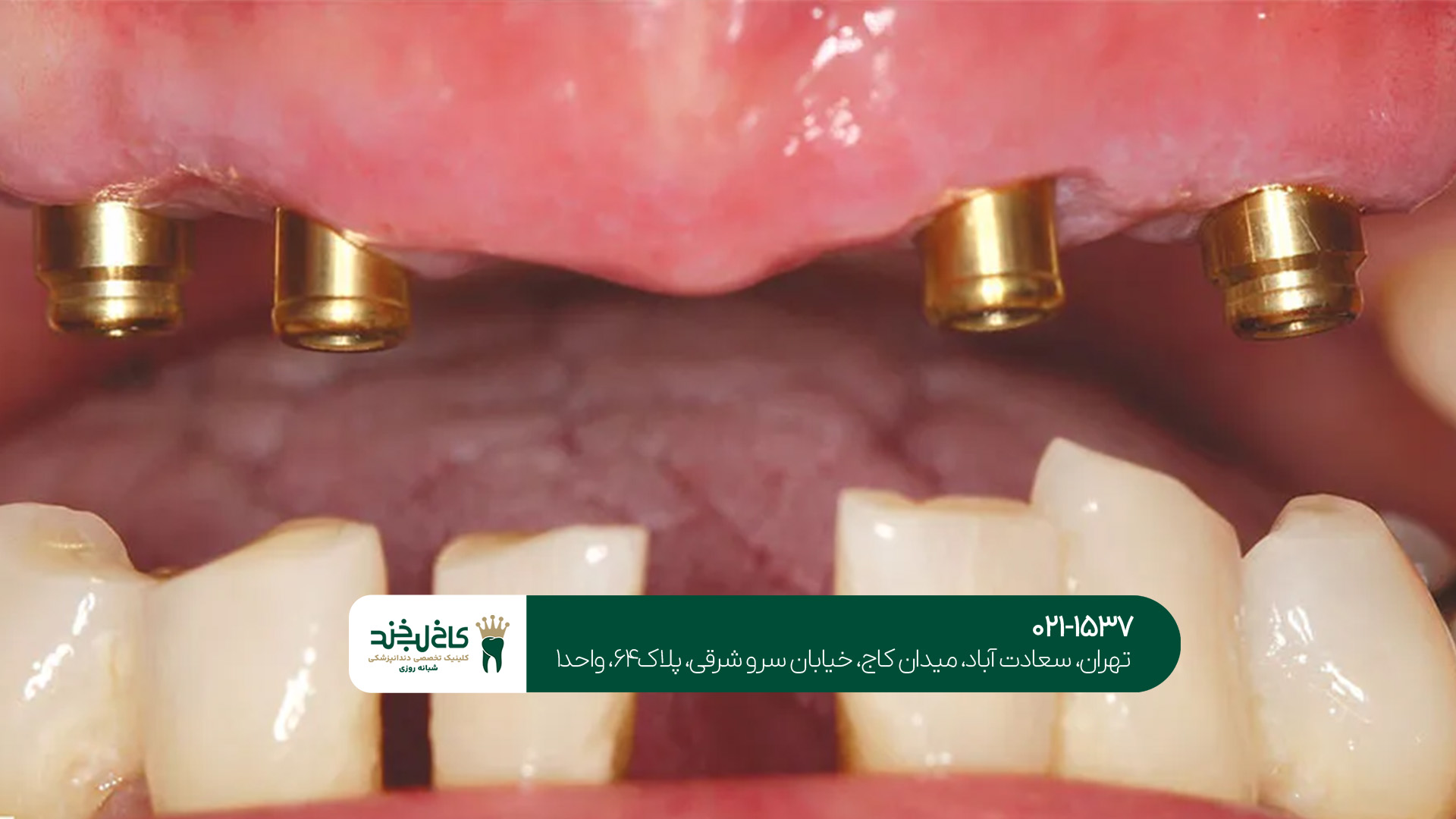  ایمپلنت یک روزه در تهران
