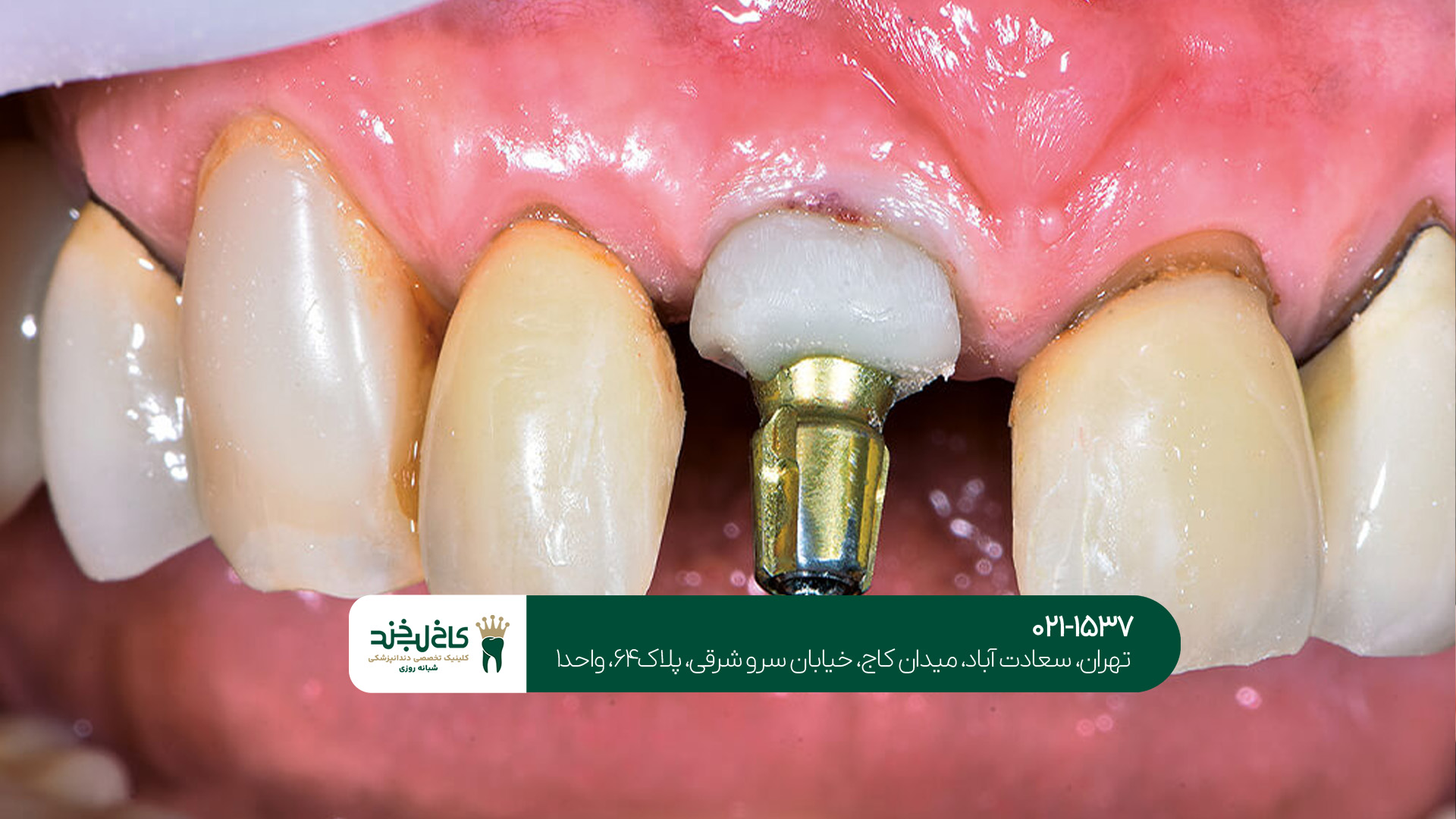  مزایای ایمپلنت فوری دندان