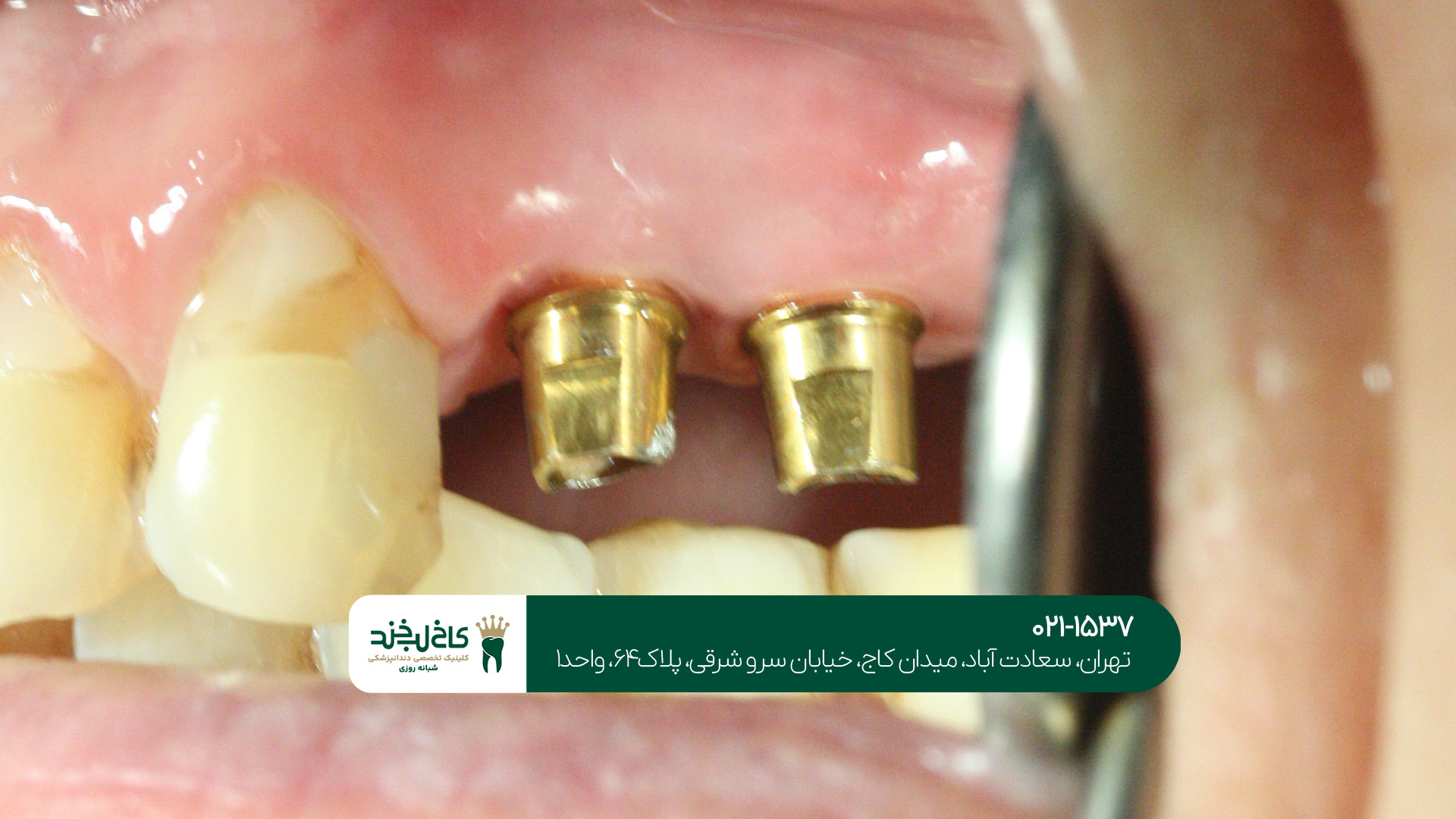 ایمپلنت فوری دندان