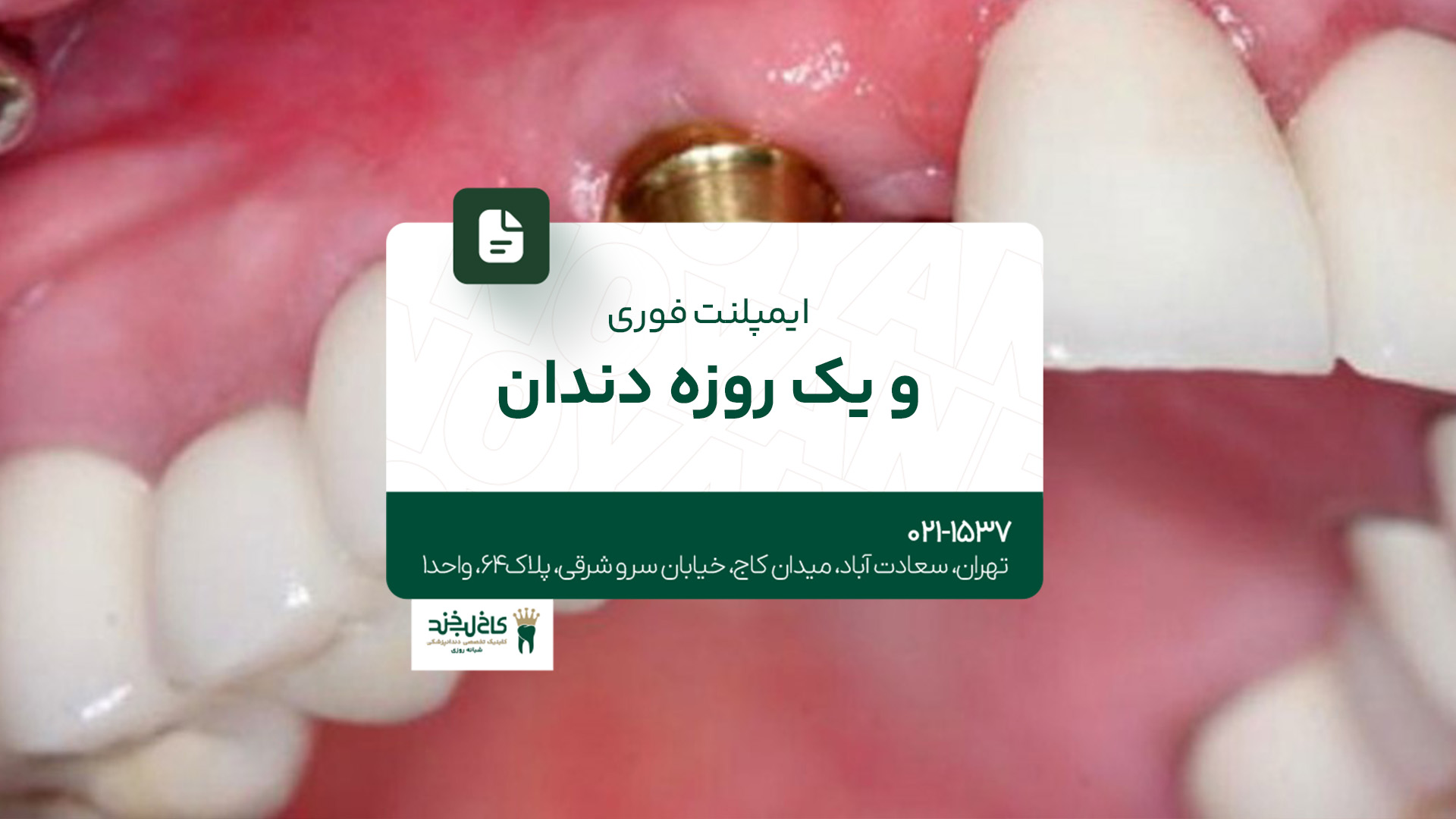 ایمپلنت فوری و یک روزه دندان