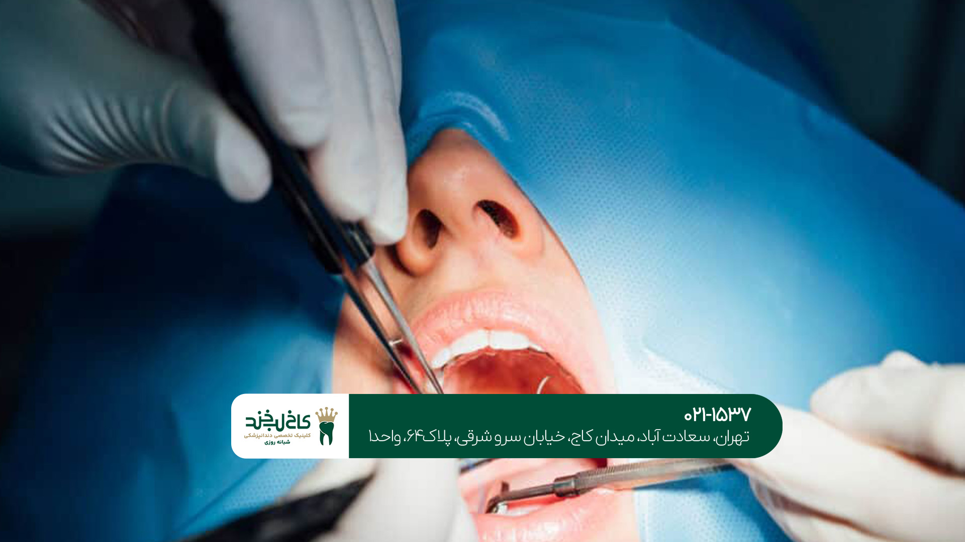 ایمپلنت یک روزه در غرب تهران