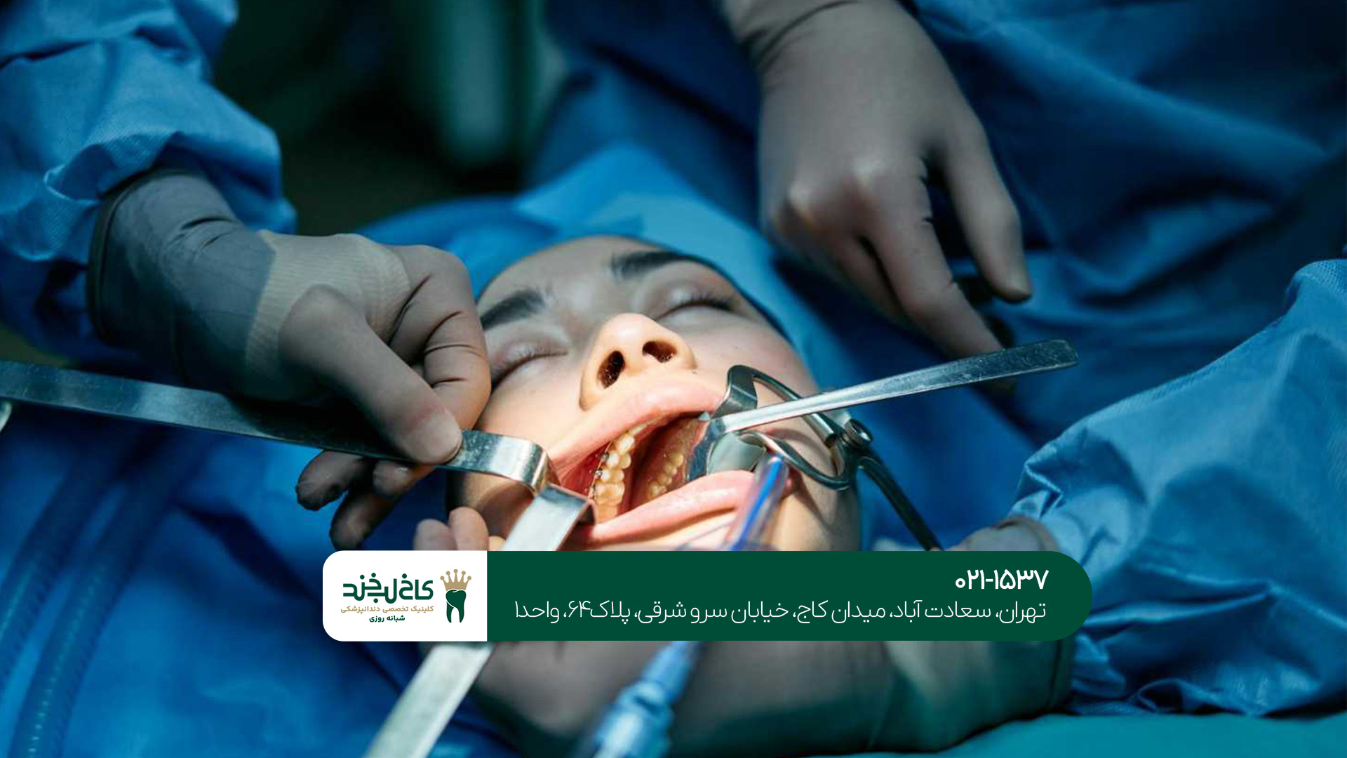 ایمپلنت یک روزه در غرب تهران