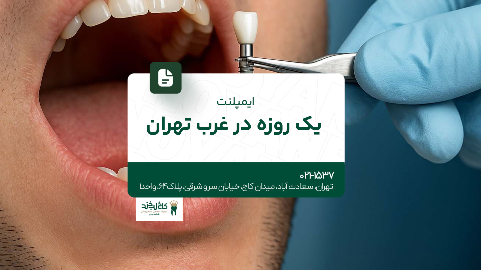 ایمپلنت یک روزه در غرب تهران