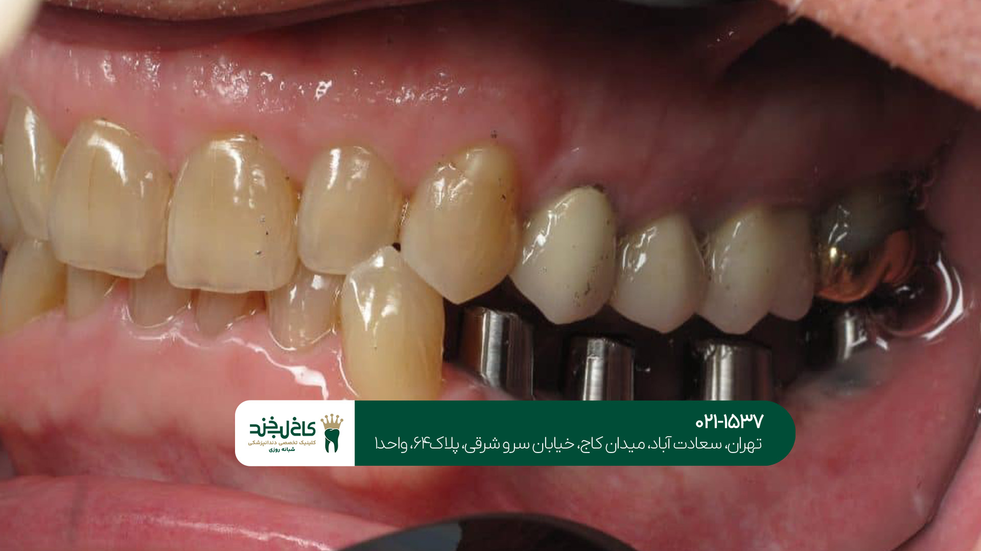 ایمپلنت دندان یک روزه در تهران