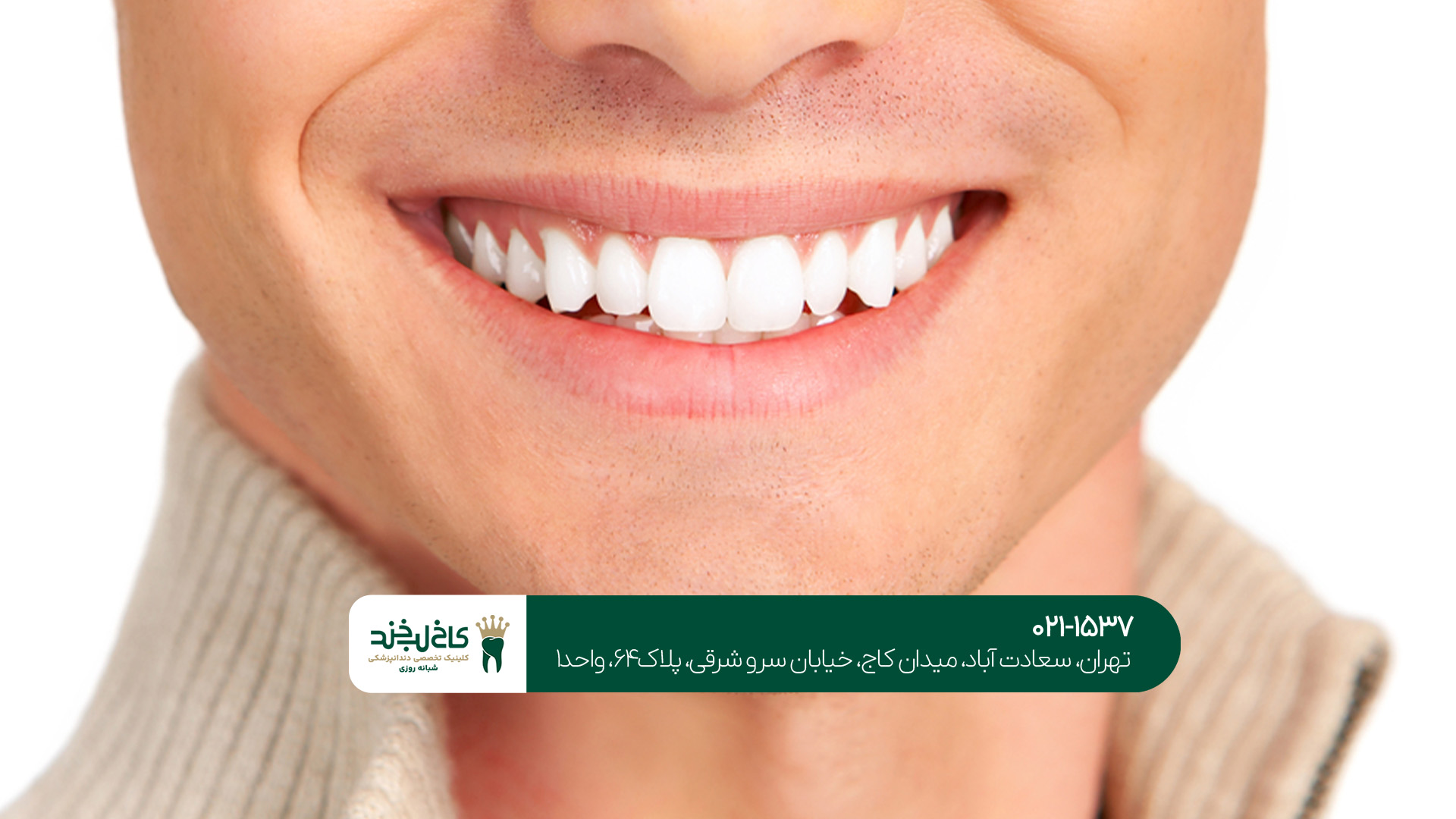 بلیچینگ دندان غرب تهران بلیچینگ دندان غرب تهران