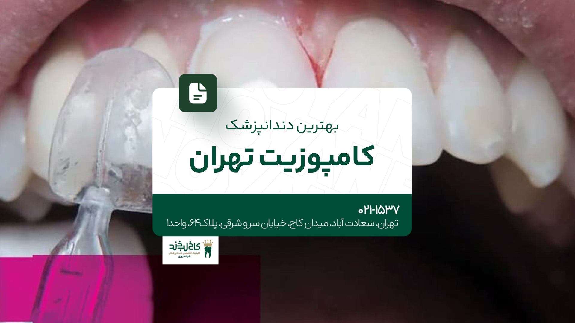 بهترین دندانپزشک کامپوزیت تهران بهترین دندانپزشک کامپوزیت تهران