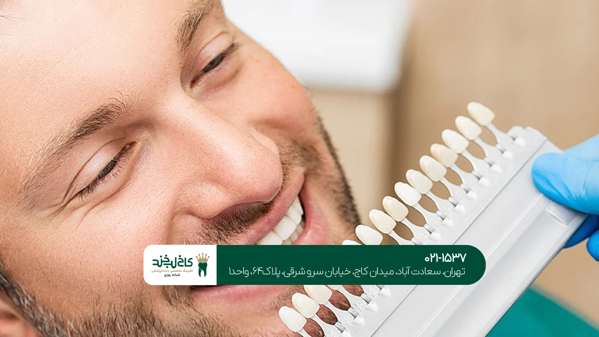 بهترین رنگ برای لمینت دندان