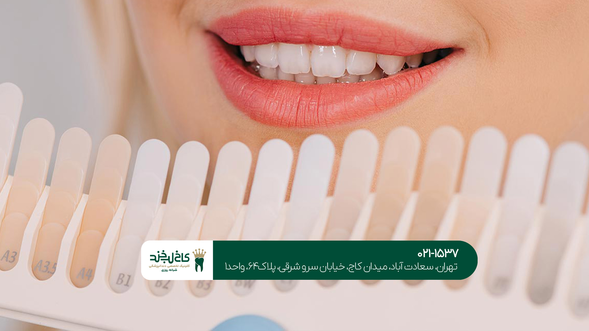 بهترین رنگ برای لمینت دندان