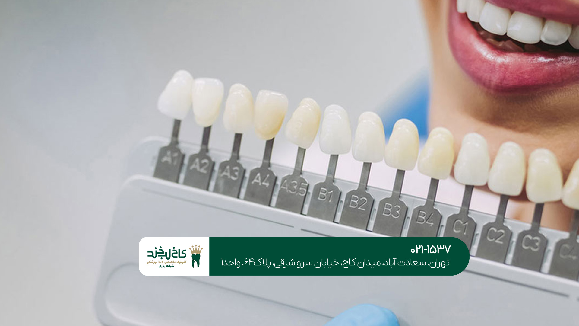 بهترین رنگ برای لمینت دندان