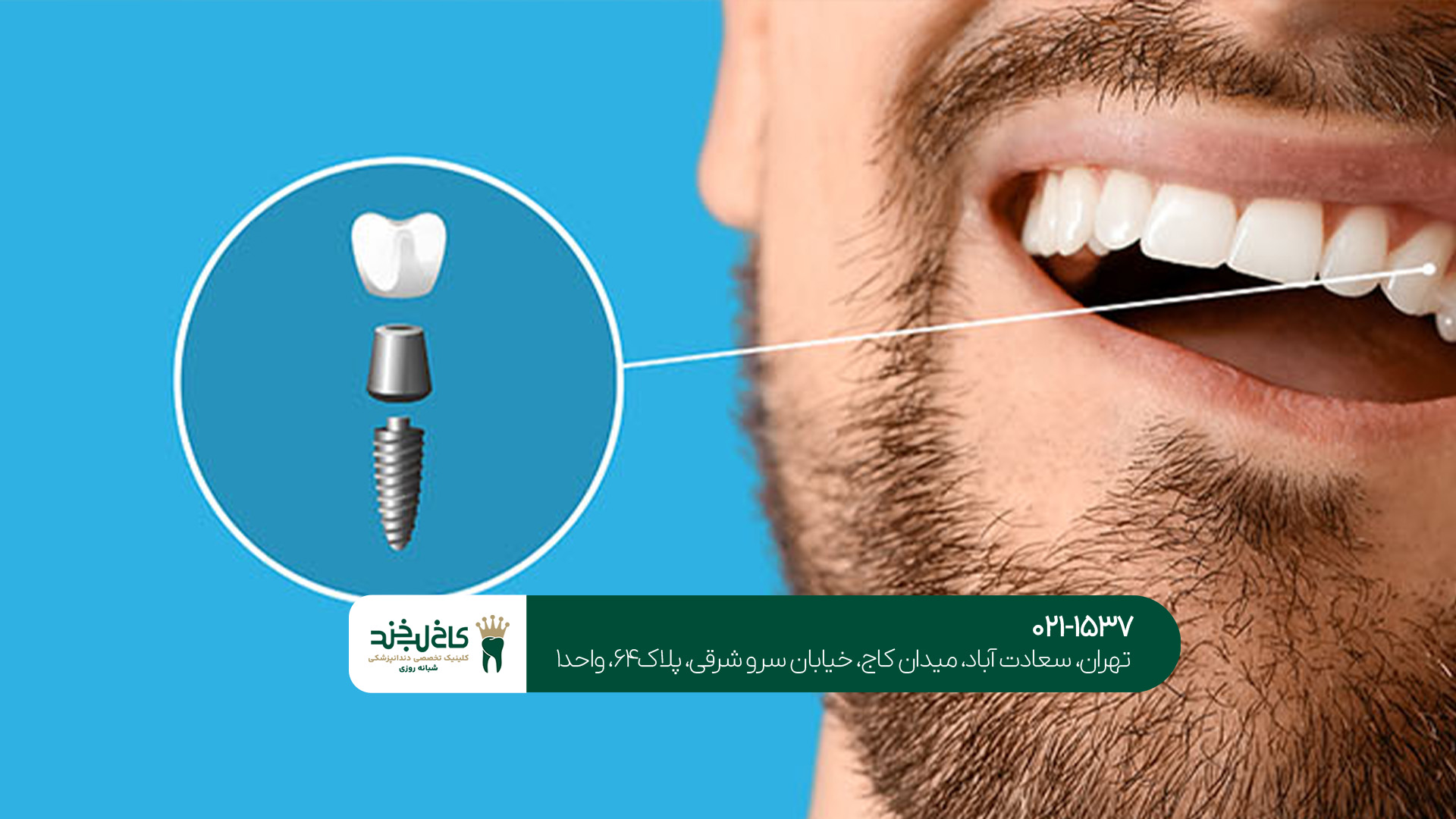 بهترین مرکز ایمپلنت تهران بهترین مرکز ایمپلنت تهران